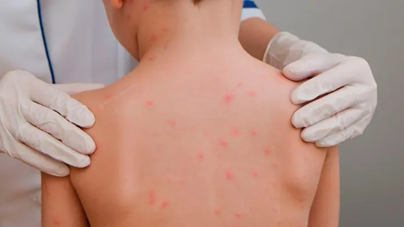 Van 12 casos de sarampión en Edomex: síntomas y cómo prevenir