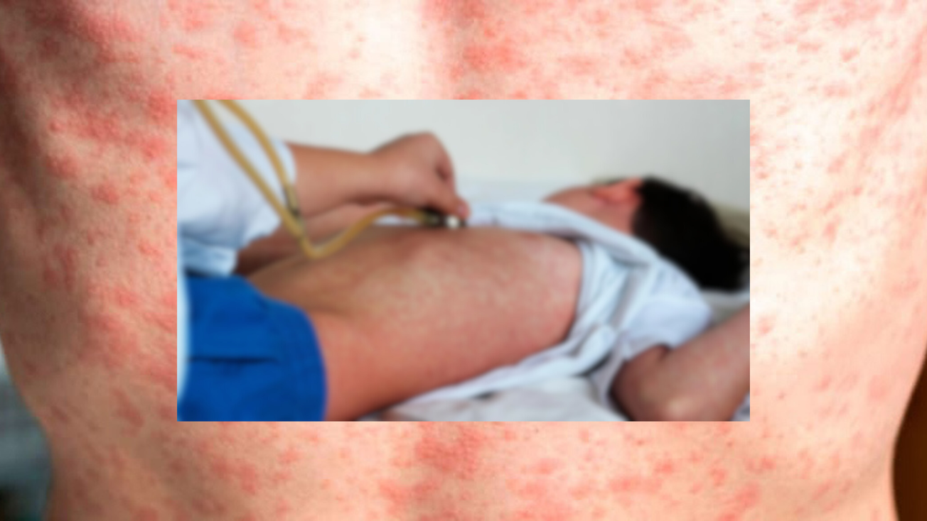 Suman 19 casos de sarampión confirmados en Edomex